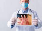 «Ковидные пальцы» – не самый частый симптом: врачи рассказали, какие ещё проблемы с кожей вызывает COVID-19